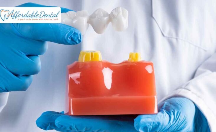 affordable bridges for teeth